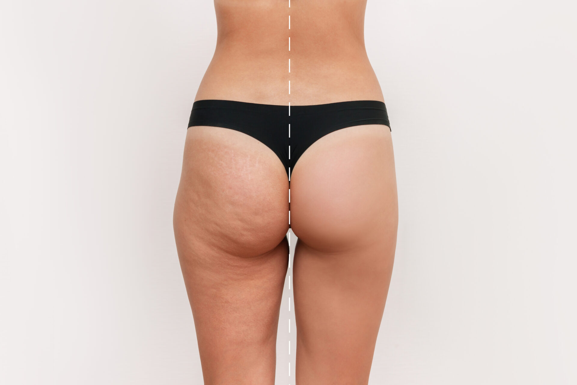 cellulite